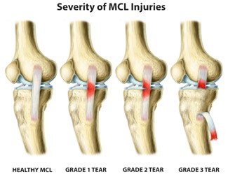 Severity-of-MCL-tear